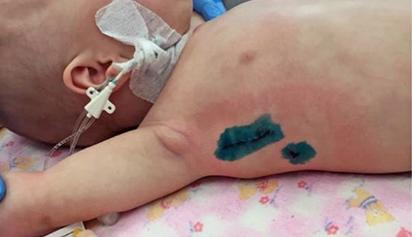 Фото ребенка через 5 дней после операции 